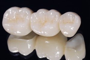 Ưu điểm của răng sứ E.Max là gì tại nha khoa ngày nay?