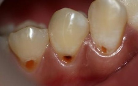 Sâu răng có nguy hiểm không?