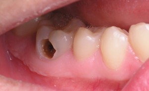 Trám răng thẩm mỹ