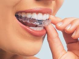 Tẩy trắng răng tại nhà