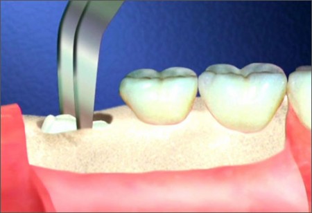 Những điều cần biết về nhổ răng