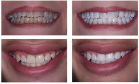 Tẩy trắng răng tại nhà như thế nào?
