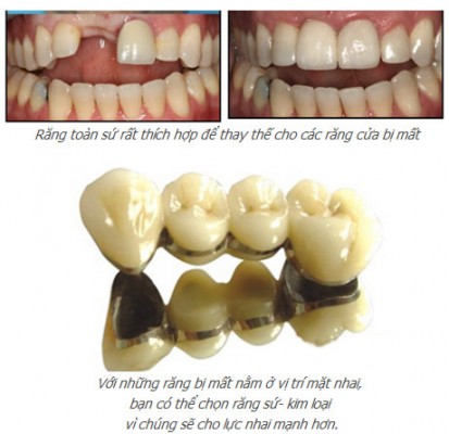 Trồng răng sứ loại nào tốt? - Niềng răng thẩm mỹ uy tín