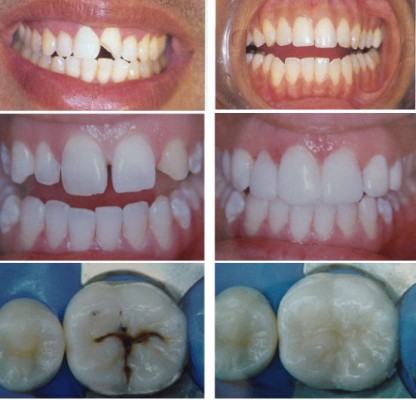 Trám răng có cần lấy tủy