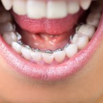 Ích lợi khi mang mắc cài cố định để chỉnh nha