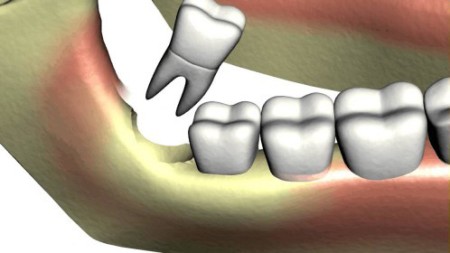 Nhổ răng khôn ở đâu uy tín