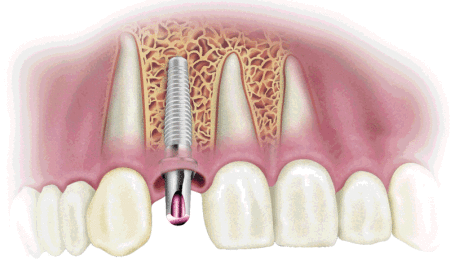 cam-rang-implant-mat-bao-lau21-450x260.gif