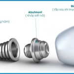 Lợi ích khi cấy ghép Implant