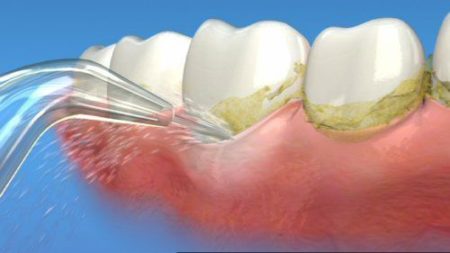 Cạo vôi răng có bị chảy máu không