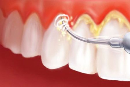 Cạo vôi răng được thực hiện thế nào?