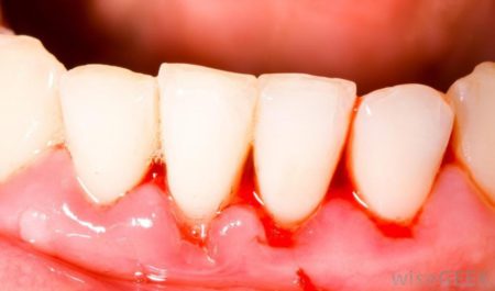Vôi răng gây chảy máu chân răng, hôi miệng là triệu chứng tiền nha chu
