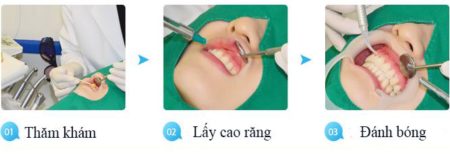 Quy trình thực hiện cạo vôi răng ở Nha Khoa
