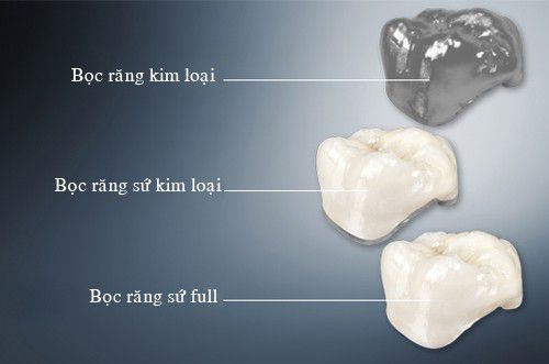 Ưu và nhược điểm của các loại răng sứ
