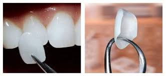 Mặt dán sứ Veneer hạn chế phải mài cùi răng