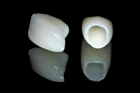 Ưu và nhược điểm của các loại răng sứ