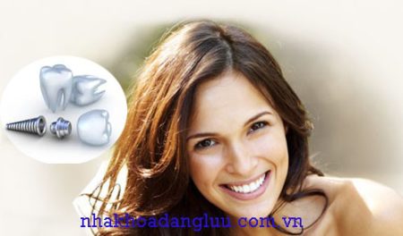 Cấy ghép implant cho răng cửa