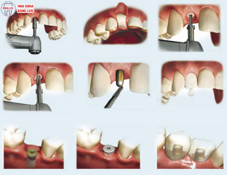 Trường hợp tiêu xương, xương hàm thiếu