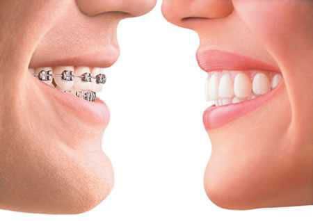Niềng răng thưa có những ưu điểm gì?