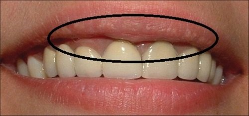 Tìm hiểu răng sứ titan sử dụng được bao lâu?-1
