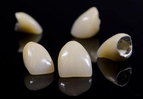 Tìm hiểu răng sứ titan sử dụng được bao lâu?-2
