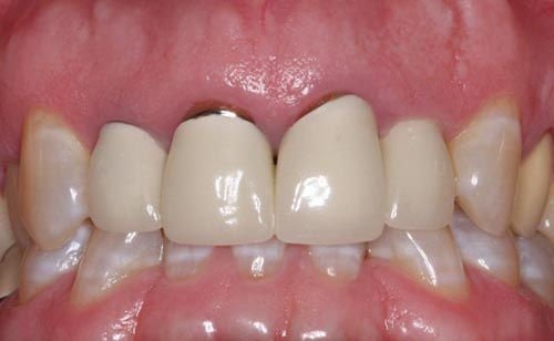 Tìm hiểu răng sứ titan sử dụng được bao lâu?-3