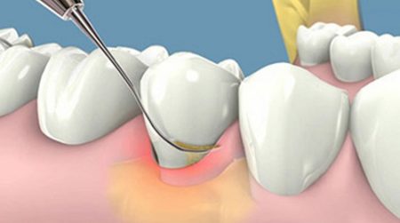 Cạo vôi răng có làm trắng răng không