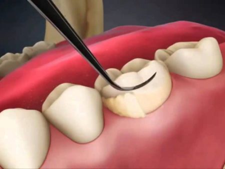 Cạo vôi răng hết bao nhiêu tiền