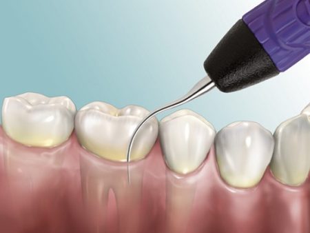 Cạo vôi răng khi mang thai có được không?