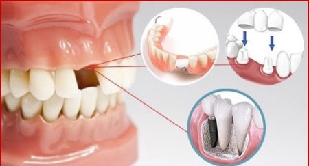 Trồng răng cửa hàm trên nên áp dụng kỹ thuật nào?