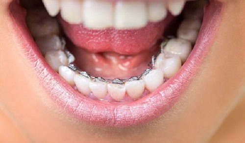 Niềng răng hàm dưới bao nhiêu tiền? Tìm hiểu dịch vụ niềng răng 2
