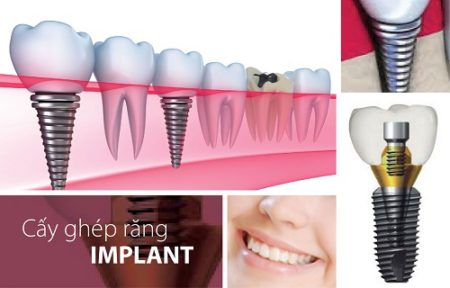 Trồng răng cấm hết bao nhiêu tiền? Chi phí có đắt không?