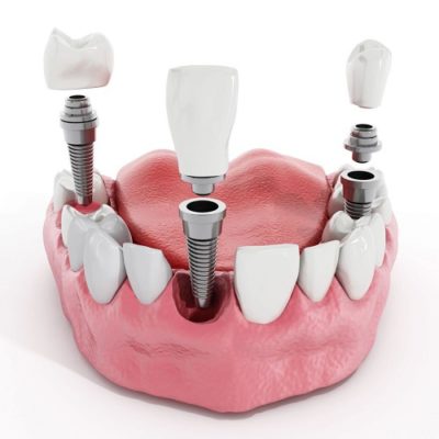 Trồng răng có ảnh hưởng gì không? Tìm hiểu về dịch vụ trồng răng