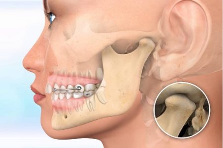 Niềng răng hàm trên bao nhiêu tiền? Các vấn đề liên quan