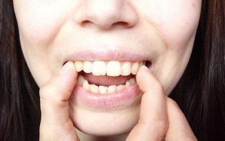 Có nên tự tẩy trắng răng ở nhà không?