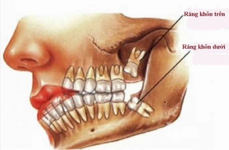 Nhổ răng khôn giá bao nhiêu? Chi phí nhổ răng khôn