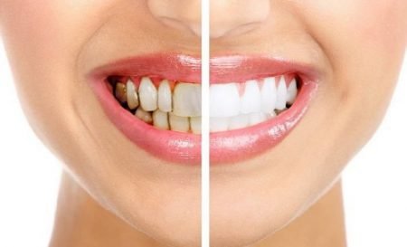 Tẩy trắng răng bị nhiễm tetracycline cho bạn hiệu quả
