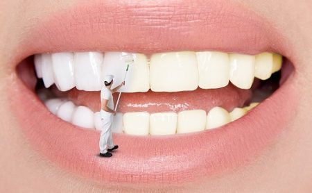 Có nên tẩy trắng răng nhiều lần hay không? Tin nha khoa