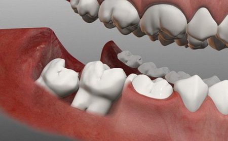 Nhổ răng khôn giá bao nhiêu tiền? Chi phí nhổ răng khôn