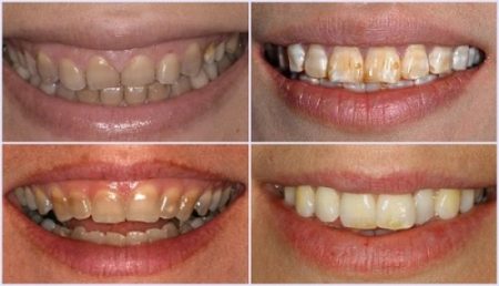 Tẩy trắng răng có ảnh hưởng gì không? Tham khảo
