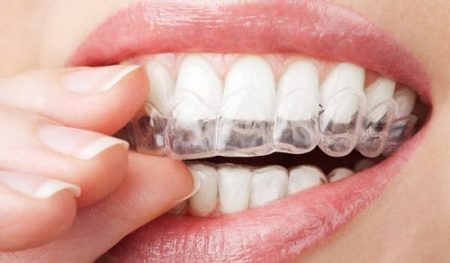 Dụng cụ niềng răng tại nhà có tốt không? Review mới nhất