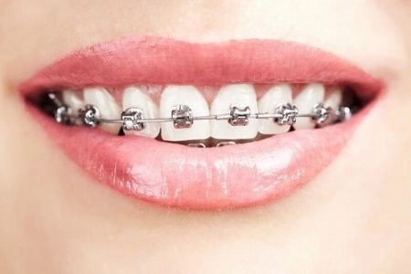 Niềng răng xong có nên tẩy trắng răng?