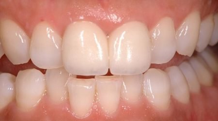 Chỉnh răng đều không cần niềng - Tham khảo cách thực hiện