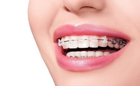 Lo lắng niềng răng có đau không 