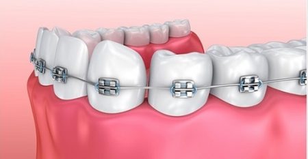 Niềng răng mắc cài 3m ugsl - Tìm hiểu về niềng răng