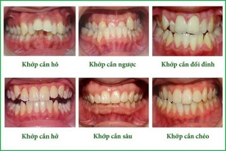 Lúc nào nên nhổ răng khôn?