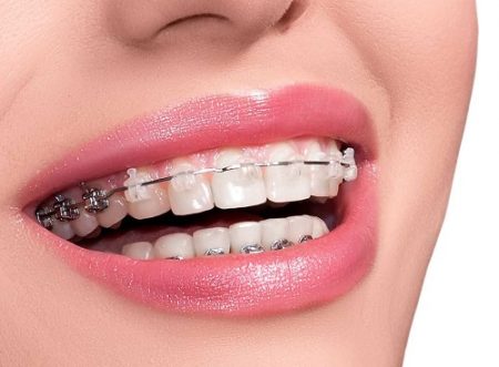 Bọc răng sứ rồi có niềng được không?