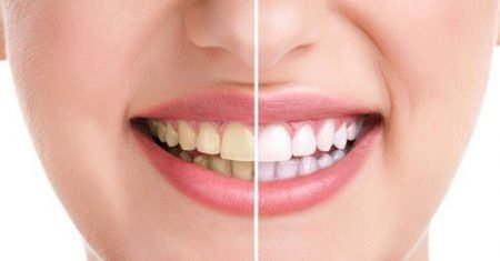 Răng sứ bị xỉn màu - Chỉ cách làm trắng hiệu quả duy nhất