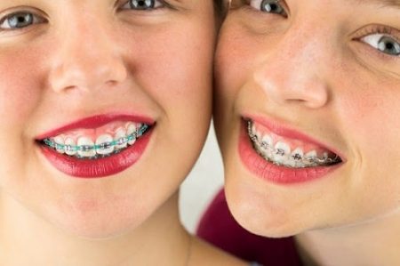 Niềng răng xong có bị hô lại không? Lo lắng của khách hàng