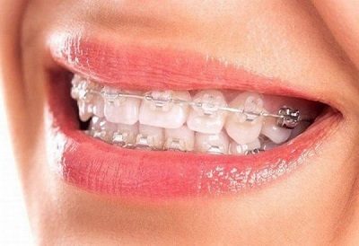 Những câu hỏi về răng sứ thường gặp hiện nay là gì?
