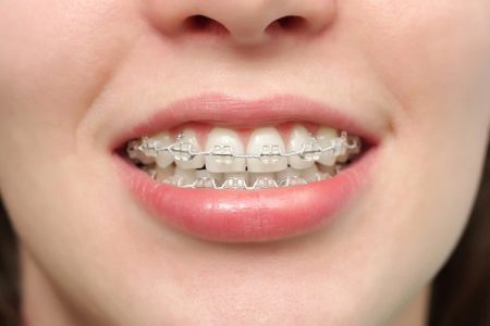 Niềng răng móm bao lâu? Thông tin cần biết trước khi niềng răng